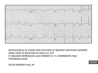 PATHOLOGICAL Q WAVES AND EVOLVING ST SEGMENT ELEVATION SIGNIFIES
STEMI, NOTE ST ELEVATION IN LEAD II, III, AVF
ST SEGMENT DEPRESSION ALSO PRESENT IN V1-3 REPRESENTS TRUE
POSTERIOR INJURY
ACUTE INFERIOR WALL MI
ECG MADE EASY
 
