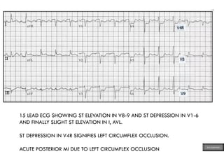 15 LEAD ECG SHOWING ST ELEVATION IN V8-9 AND ST DEPRESSION IN V1-6
AND FINALLY SLIGHT ST ELEVATION IN I, AVL.
ST DEPRESSION IN V4R SIGNIFIES LEFT CIRCUMFLEX OCCLUSION.
ACUTE POSTERIOR MI DUE TO LEFT CIRCUMFLEX OCCLUSION ECG MADE EASY
 
