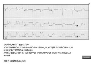 SIGNIFICANT ST ELEVATION
ACUTE INFERIOR STEMI FINDINGS IN LEAD II, III, AVF (ST ELEVATION IN II, III
AND ST DEPRESSION IN LEAD I)
AND ST ELEVATION IN V3R TO V6R ;INDICATIVE OF RIGHT VENTRICULAR
INJURY
RIGHT VENTRICULAR MI
ECG MADE EASY
 
