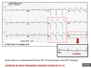 Acute anterior or anterolateral MI (note Q's V2-6 plus hyper acute ST-T changes)
ANTERIOR MI SINCE PROMINENT CHANGES FOUND IN V2, V3
Q WAVE
ECG MADE EASY
 