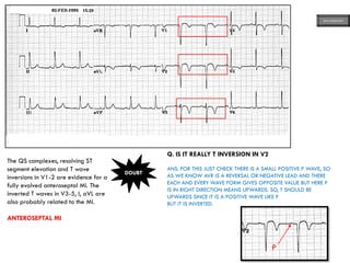 The QS complexes, resolving ST
segment elevation and T wave
inversions in V1-2 are evidence for a
fully evolved anteroseptal MI. The
inverted T waves in V3-5, I, aVL are
also probably related to the MI.
ANTEROSEPTAL MI
DOUBT
Q. IS IT REALLY T INVERSION IN V2
ANS. FOR THIS JUST CHECK THERE IS A SMALL POSITIVE P WAVE, SO
AS WE KNOW AVR IS A REVERSAL OR NEGATIVE LEAD AND THERE
EACH AND EVERY WAVE FORM GIVES OPPOSITE VALUE BUT HERE P
IS IN RIGHT DIRECTION MEANS UPWARDS. SO, T SHOULD BE
UPWARDS SINCE IT IS A POSITIVE WAVE LIKE P
BUT IT IS INVERTED.
P
ECG MADE EASY
 