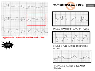 Hyperacute T waves in inferior wall STEMI
DOUBT
WHY INFERIOR WALL STEMI
IN LEAD II MARKED ST ELEVATION FOUND
IN LEAD III ALSO MARKED ST ELEVATION
FOUND
IN AVF ALSO MARKED ST ELEVATION
FOUND
ECG MADE EASY
 