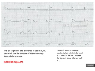 The ST segments are elevated in Leads II, III,
and aVF, but the amount of elevation may
look subtle to some.
INFERIOR WALL MI
This ECG shows a common
manifestation with inferior wall
M.I., BRADYCARDIA. We see
the signs of acute inferior wall
M.I.
ECG MADE EASY
 