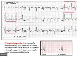 QQQQQQQQQQQQQQQQQQQQ
ST segment depression is a nonspecific
abnormality that must be evaluated in the
clinical context in which it occurs. In a patient
with angina pectoris ST depression usually
means subendocardial ischemia.
ECG MADE EASY
 
