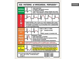 ECG MADE EASY
 
