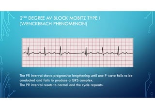Type I Block ECG Series on Other Parts of ECG as part of requirement | PDF