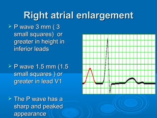 Right atrial enlargement
   P wave 3 mm ( 3
    small squares) or
    greater in height in
    inferior leads

   P wave 1.5 mm (1.5
    small squares ) or
    greater in lead V1

   The P wave has a
    sharp and peaked
    appearance
 