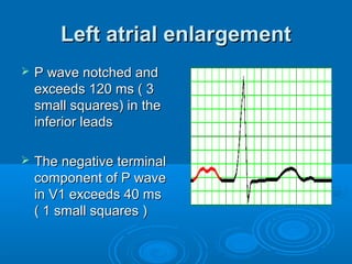 Left atrial enlargement
   P wave notched and
    exceeds 120 ms ( 3
    small squares) in the
    inferior leads

   The negative terminal
    component of P wave
    in V1 exceeds 40 ms
    ( 1 small squares )
 