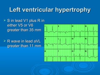 Left ventricular hypertrophy
   S in lead V1 plus R in
    either V5 or V6
    greater than 35 mm

   R wave in lead aVL
    greater than 11 mm
 
