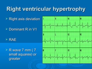 Right ventricular hypertrophy
   Right axis deviation

   Dominant R in V1

   RAE

   R wave 7 mm ( 7
    small squares) or
    greater
 