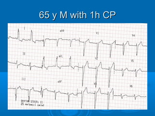 65 y M with 1h CP
 