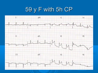 59 y F with 5h CP
 