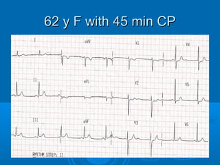 62 y F with 45 min CP
 