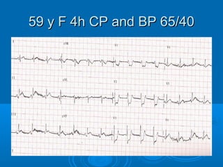 59 y F 4h CP and BP 65/40
 