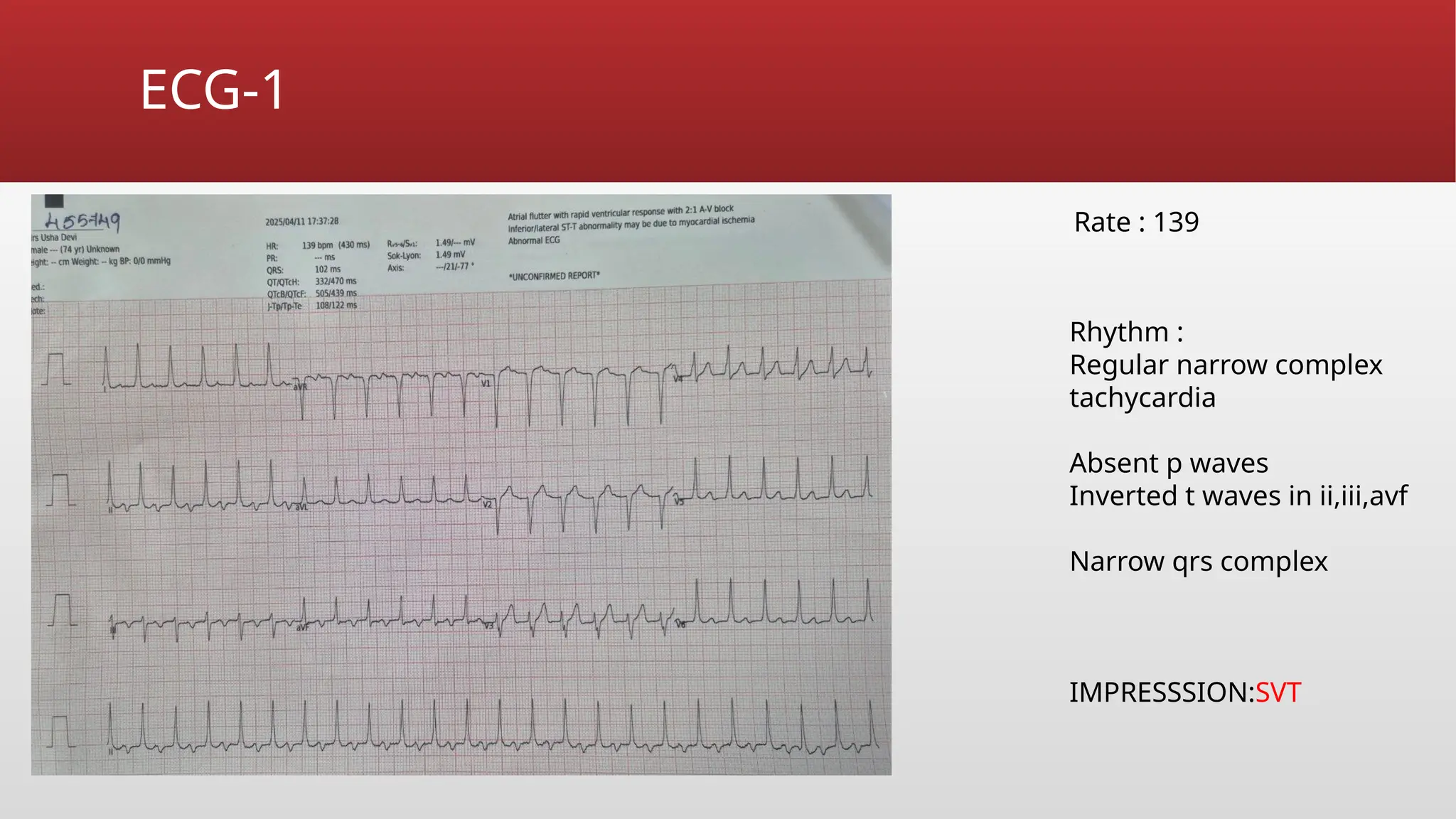 ECG sick sinus syndrome in emergency dept .pptx