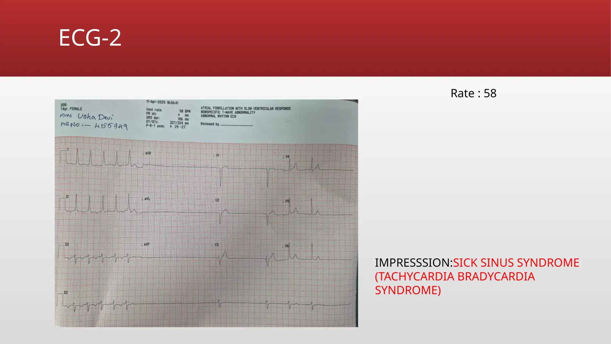 ECG sick sinus syndrome in emergency dept .pptx