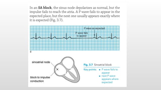 ECG sick sinus syndrome in emergency dept .pptx