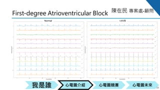 心電圖競賽心電圖介紹我是誰 心電圖未來
陳在民 專案處-顧問
First-degree Atrioventricular Block
15
Normal I-AVB
 