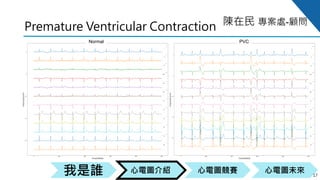 心電圖競賽心電圖介紹我是誰 心電圖未來
陳在民 專案處-顧問
Premature Ventricular Contraction
17
Normal PVC
 