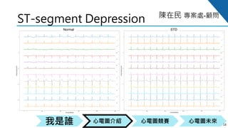 心電圖競賽心電圖介紹我是誰 心電圖未來
陳在民 專案處-顧問
ST-segment Depression
18
Normal STD
 