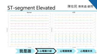 心電圖競賽心電圖介紹我是誰 心電圖未來
陳在民 專案處-顧問
ST-segment Elevated
19
Normal STE
 