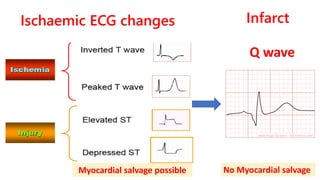 Ischaemic ECG changes
Q wave
Infarct
Myocardial salvage possible No Myocardial salvage
 