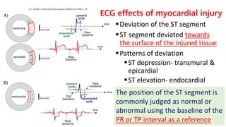 ECG effects of myocardial injury
▪Deviation of the ST segment
▪ST segment deviated towards
the surface of the injured tiss...