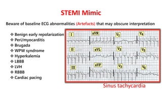 ▪ Clinical correlation: Any suspicious ECG findings should be matched against
patient presentation and physical exam.
▪ Hi...