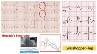 Hyperkalemia
• ECG findings that can resemble ACS
• ECG presentation may correlate unreliably with level of serum K
• Hist...