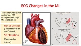 TRANSMURAL Injury
ST Elevation
ECG Changes in the MI
There are two distinct
patterns of ECG
change depending if
the infarc...