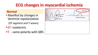 ECG changes in myocardial ischemia
• Manifest by changes in
Ventricle repolarization
(ST segment and T waves)
▪ST- isoelec...