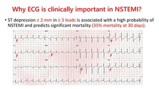 Why ECG is clinically important in NSTEMI?
• ST depression ≥ 2 mm in ≥ 3 leads is associated with a high probability of
NS...