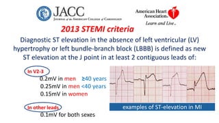2013 STEMI criteria
Diagnostic ST elevation in the absence of left ventricular (LV)
hypertrophy or left bundle-branch bloc...