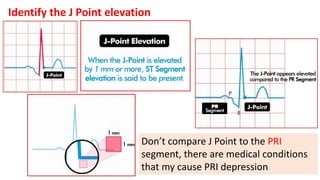 Identify the J Point elevation
The TP segment
provides the best
baseline to evaluate ST
elevation
▪ Locate the J-Point
▪ C...