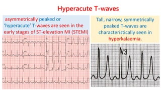 Q wave
• Normal
✓Lateral leads (I,aVL,V5,V6)
✓III alone may be present
Pathologic Q-waves
▪ ¼ of following R wave
▪ >0.04s...