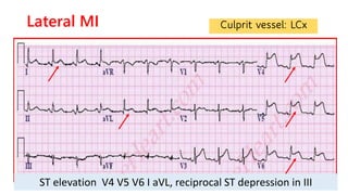 Inferior MI
• ST-Elevation in leads II,III, and AVF
• Reciprocal changes in leads I and AVL
Culprit vessel: RCA
 