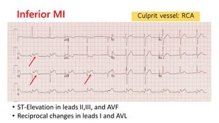 Inferior Infarction
Right coronary artery
• ST elevation Lead III > Lead II
• AV nodal block
• ST-segment vector is direct...