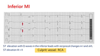 Association of inferior wallMI
✓Heart block ( any degree )
✓sinus node disease
✓Posterior wall MI
✓RV infarction
✓Mechanic...