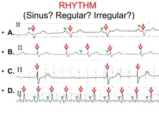 Sinus R1 Ecg skills enhancement | PPT
