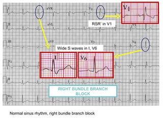 Rsr Rbbbb Ecg skills enhancement | PPT