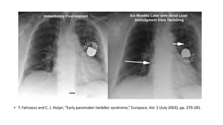 • T. Fahraeus and C. J. Hoijer, “Early pacemaker twiddler syndrome,” Europace, Vol. 5 (July 2003), pp. 279-281.
 