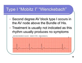 Type I Block Ecg step by step not by me | PPTX