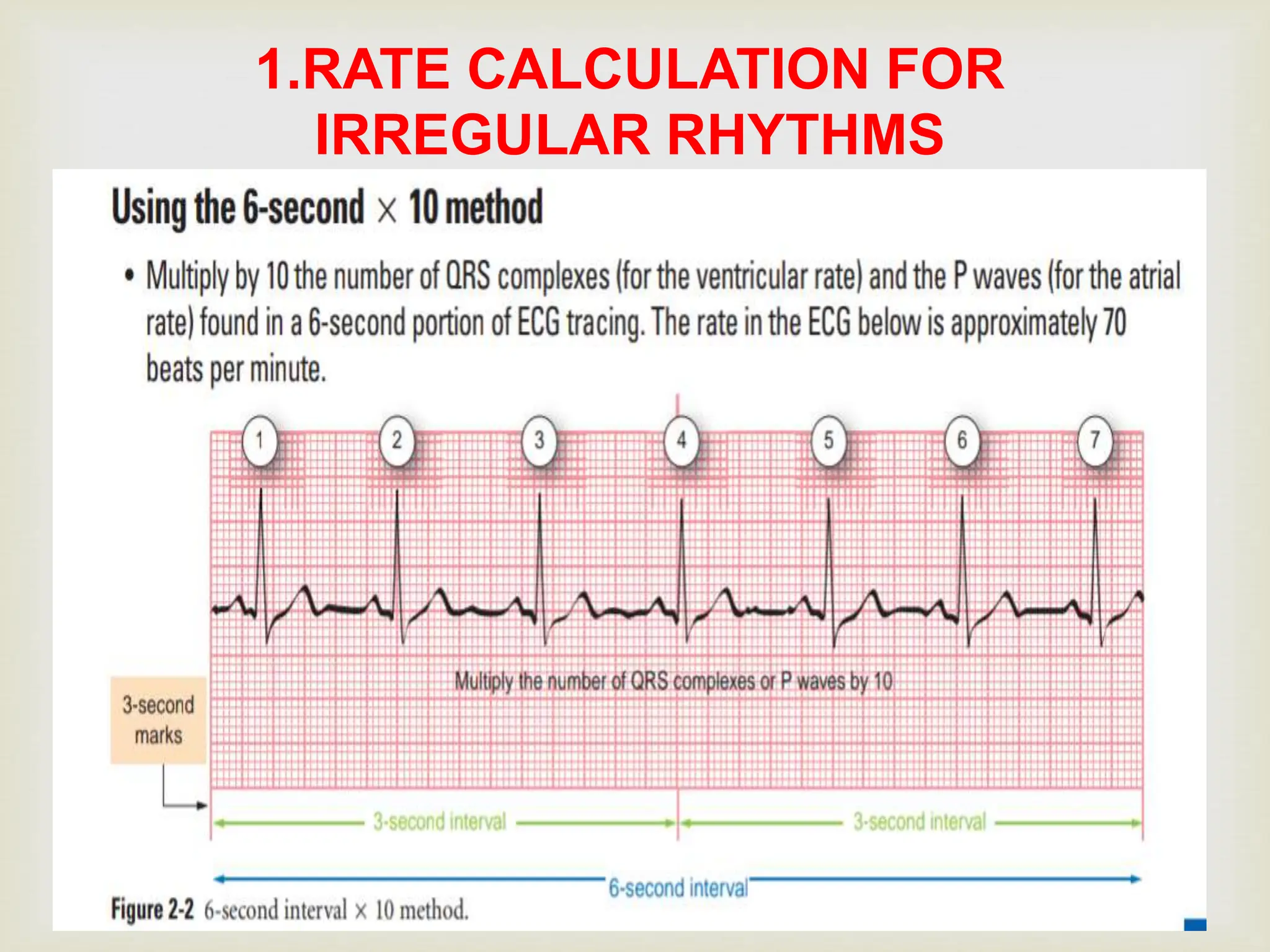 Ecg Irregular Rythm Rad Irregular Rhythm Ecg Calculation