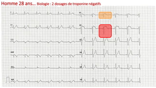 Homme 28 ans… Biologie : 2 dosages de troponine négatifs
 