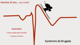 Homme 23 ans… mis à l’UHCD
Syndrome de Brugada
Anamnèse
3 morts subites dans la famille
1 oncle et 2 cousins
 