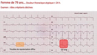 Femme de 79 ans… Douleur thoracique atypique > 24 h.
Examen : râles crépitants déclives
QT longTroubles de repolarisation diffus
 