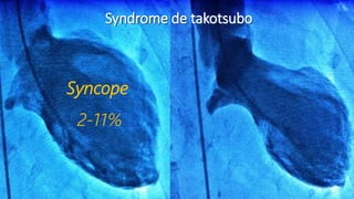 A.1-1
•QT long
Syndrome de takotsubo
Syncope
2-11%
 