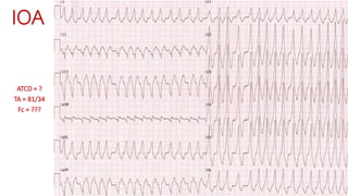 A.1-1
ATCD = ?
TA = 81/34
Fc = ???
IOA
 
