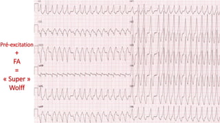A.1-1
Pré-excitation
+
FA
=
« Super »
Wolff
 