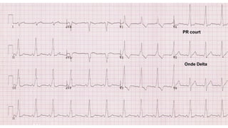 A.1-1
Onde Delta
PR court
 